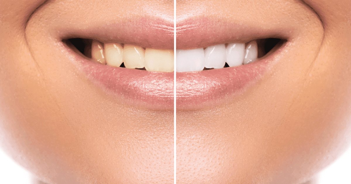 Tooth Whitening Choices: Which One Is Proper for You?