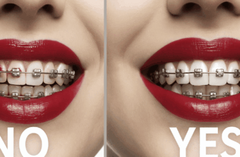 How To Put on Lipstick With Braces As An Grownup