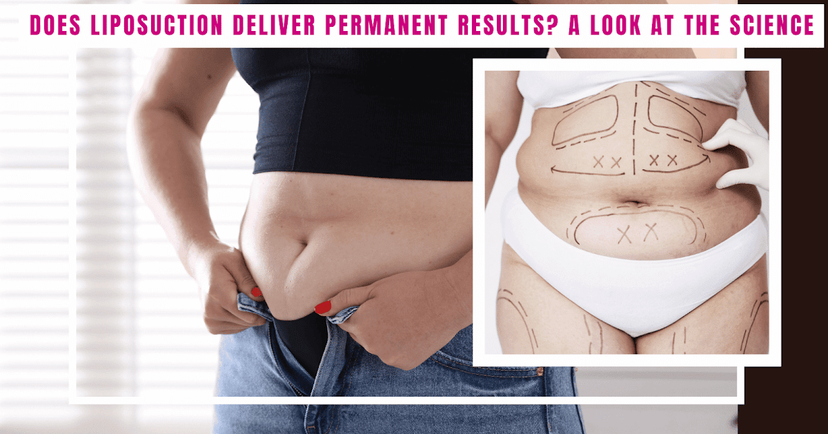 Does Liposuction Ship Everlasting Outcomes? A Take a look at the Science