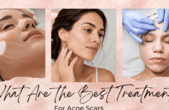 What Are the Greatest Remedies for Zits Scars?