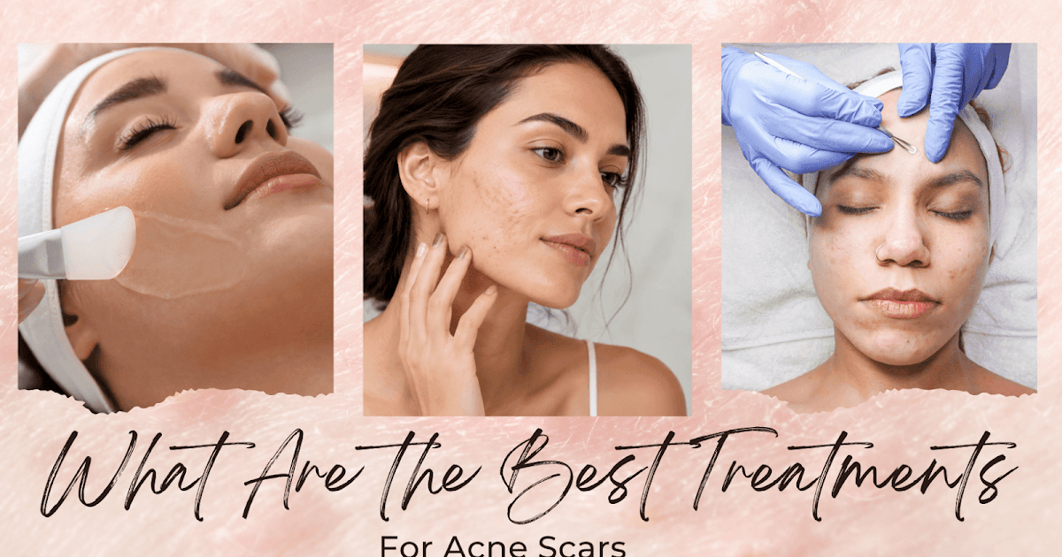 What Are the Greatest Remedies for Zits Scars?