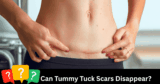 Do Tummy Tuck Scars Disappear—Or Can They Change into a Masterpiece?